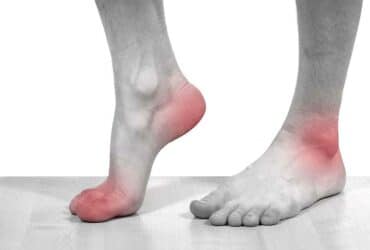 Understanding the Causes of Gout