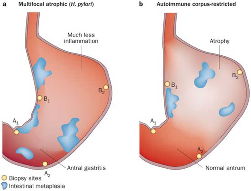 Understanding Gastritis: Symptoms