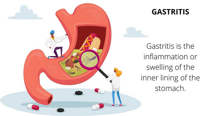 Understanding Gastritis: Symptoms